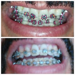 Beginning and end of braces