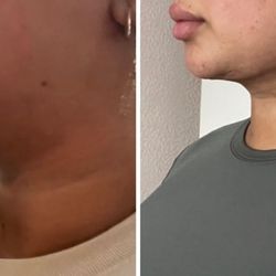 Desert Plastic Surgery Center - Chin lipo and lift