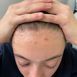 Proderma Acne Systems for Teens 
