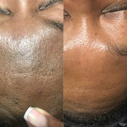 Kim B Brows & Skincare - Microdermabrasion
