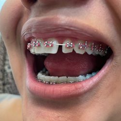 Ventura County Orthodontics - The gap I had months into the treatment as well as my front tooth shifting outward, it was perfect and aligned before