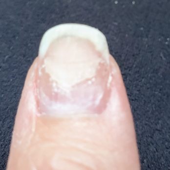 4 Seasons Nails and Spa - Left thumb, with large amount of remaining acrylic. - Nail Salons Near Me - Mesa, Arizona 4 Seasons Nails and Spa - Left thumb, with large amount of remaining acrylic. - Nail Salons Near Me - Mesa, Arizona