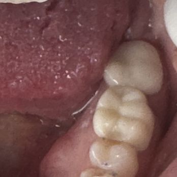 Rancho San Diego Dentists - Back molar is crown from Rancho San Diego and one below is new crown from new dentist - General Dentistry Near Me - La Mesa, California Rancho San Diego Dentists - Back molar is crown from Rancho San Diego and one below is new crown from new dentist - General Dentistry Near Me - La Mesa, California