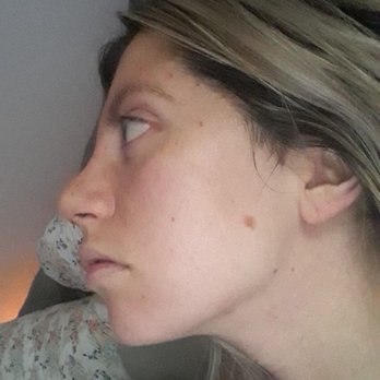 Esthetica Orange County - Only 2 weeks post OP:) - Cosmetic Surgeons Near Me - Newport Beach, California