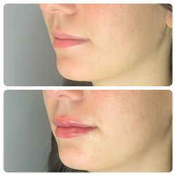SkinLab Laser Aesthetics & Wellness - Lip Filler