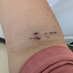 Talecris Plasma Resources - Bruising and blood vessels popped at the puncture site.