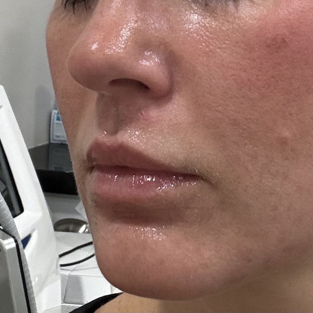 Side profile before lip filler Side profile before lip filler