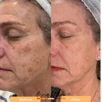 Brightside Esthetics - Year update. This client never took care of her skin a day in her life until Brightside Esthetics. Look at her now! - Skin Care Near Me - Huntington Beach, California Brightside Esthetics - Year update. This client never took care of her skin a day in her life until Brightside Esthetics. Look at her now! - Skin Care Near Me - Huntington Beach, California