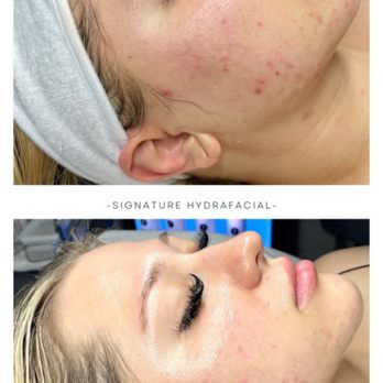 Sculpted Wellness Spa - Signature Hydrafacial - $179 - Body Contouring Near Me - Sacramento, California Sculpted Wellness Spa - Signature Hydrafacial - $179 - Body Contouring Near Me - Sacramento, California