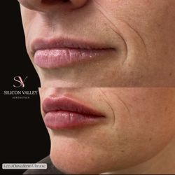 Silicon Valley Aesthetics - Lip Augmentation