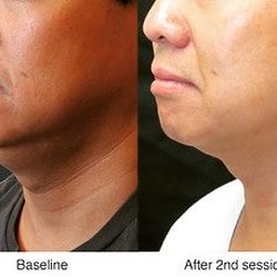 Face By Fong - Kybella