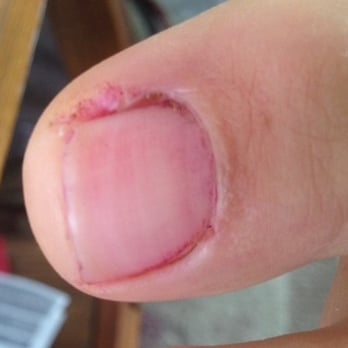 Bella Nails & Spa - painful pedicure ended up like this! - Skin Care Near Me - Riverside, California Bella Nails & Spa - painful pedicure ended up like this! - Skin Care Near Me - Riverside, California