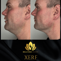 Bella Vida Medspa - XERF Radiofrequency Non-Surgical Skin Tightening in Temecula, CA