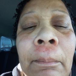 Classic Eyebrow Threading - Burning and swollen.