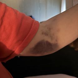 BioLife Plasma Services - My arm next day, and following days
