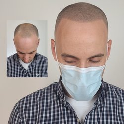 Adding density to hair transplant with Scalp Micro Pigmentation in Houston, Texas