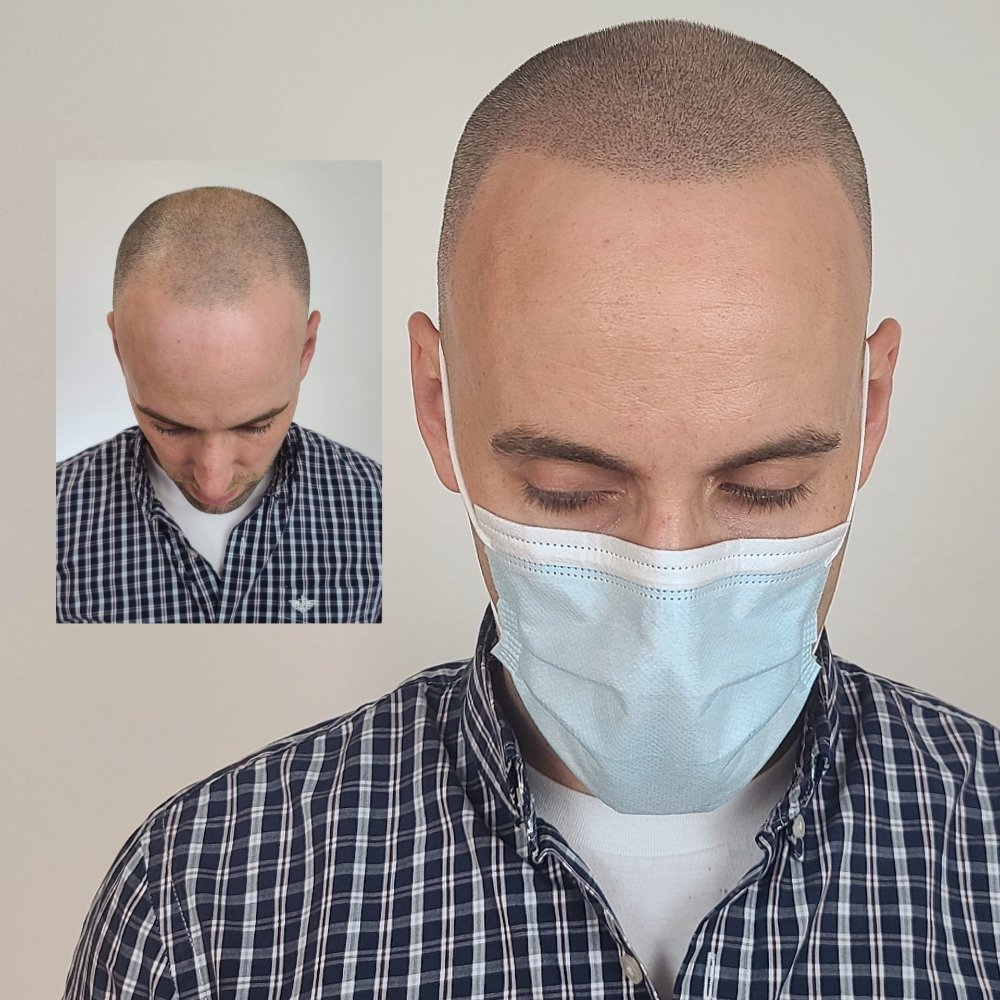 SCALPP CLINIC SCALP MICROPIGMENTATION Updated October 2024 67 Photos & 12 Reviews 1315