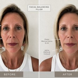Botox Kailua - Facial Balancing