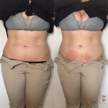 Cryohub - Boston - Before and after first session - Cryotherapy Near Me - Boston, Massachusetts