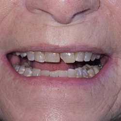 Dr J Tim Rainey DDS Magd - Our typical weekly "Magic" with Composite repair. Not every dentist can do this.