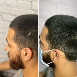 Hatfish Scalp Micropigmentation - Scar cover up