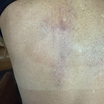 Grotto Spa - Solana Beach - My back after my message !!! - Massage Near Me - Solana Beach, California