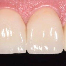 Jonathan J Golab, DDS PA - Porcelain Veneers 2 After