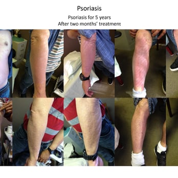 Blossoming Lotus Acupuncture - Psoraisis for 5 years. After 2 months' treatment. - Acupuncture Near Me - San Francisco, California Blossoming Lotus Acupuncture - Psoraisis for 5 years. After 2 months' treatment. - Acupuncture Near Me - San Francisco, California