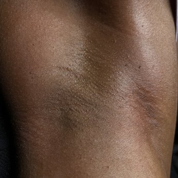 Sugar & Skin by Morgan - After - underarms - Estheticians Near Me Sugar & Skin by Morgan - After - underarms - Estheticians Near Me