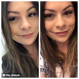 2 days post versa filler with Leslie. 1ml