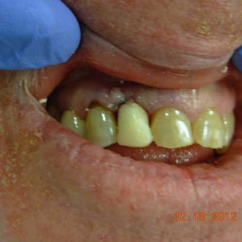 Gentle Dentistry - Tooth be extracted-implant placed with temporary crown - General Dentistry Near Me - Modesto, California