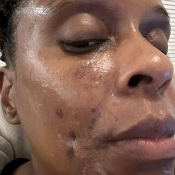 Ibeauty Med Spa - Blisters and inflammation after chemical peel service
