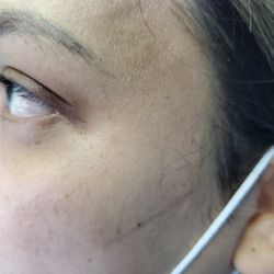 SILICON VALLEY WEIGHT LOSS SKINCARE CLINIC - Crows feet