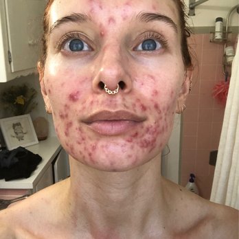 Metropolis Dermatology - At its worst - Dermatologists Near Me - Los Angeles, California Metropolis Dermatology - At its worst - Dermatologists Near Me - Los Angeles, California