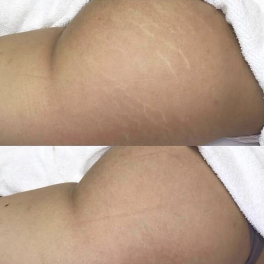 Boleyn studio - Before/after treatment - Permanent Makeup Near Me - Beverly Hills, California Boleyn studio - Before/after treatment - Permanent Makeup Near Me - Beverly Hills, California