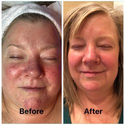 Cindy Ann Ravn - Wondering what I can to help with Rosacea? A lot.  Call, text or message me or book your appointment at www.cindyravn.com.