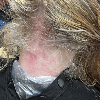 Alpine Hair and Day Spa - Chemical burns and blisters on neck and back of head. - Hair Salons Near Me - Comstock Park, Michigan Alpine Hair and Day Spa - Chemical burns and blisters on neck and back of head. - Hair Salons Near Me - Comstock Park, Michigan