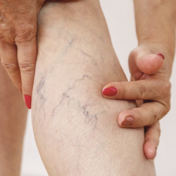 Minneapolis Vein Center