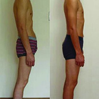 Elias Limberopoulos - Chicago - Before and After the Rolfing Ten Session Series - Physical Therapy Near Me - Chicago, Illinois Elias Limberopoulos - Chicago - Before and After the Rolfing Ten Session Series - Physical Therapy Near Me - Chicago, Illinois