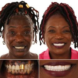 Louisiana Implants and Dentures - Full mouth dental implant transformation