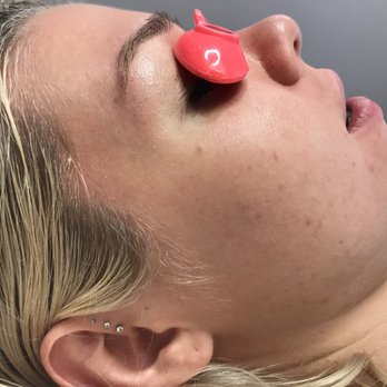www.elementsacneclinic.com - At my last acne treatment-2 1/2 months later! - Skin Care Near Me - Parkway, Alaska