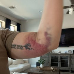 South Texas Blood And Tissue Center - Westover Hills Donor Room - Bruises day 1