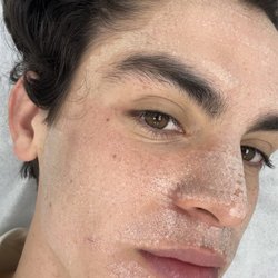 Dermatology + Aesthetics - Lakeview - NanoLaserPeel