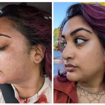 Skin Alchemy Collective - Immediately after vs morning after - Medical Spas Near Me - Wilton Manors, Florida Skin Alchemy Collective - Immediately after vs morning after - Medical Spas Near Me - Wilton Manors, Florida