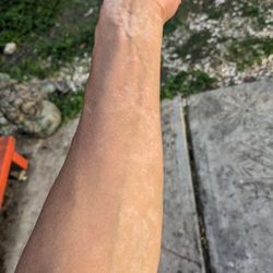 Missouri Dermatology - Scabies misdiagnosed and under treated. Had to find outside help to cure.