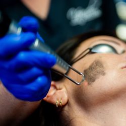 Vanish Laser & Skin - Carbon laser facials exfoliate and reduce pigmentation and sun damage.