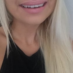 Sunset Dental - Right front tooth chip filled in! Perfect match!!
