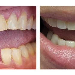 CLE Smiles by Dr Niki - Before and after smile of a patient