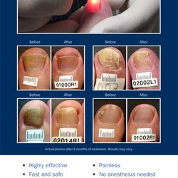 Grzywacz Robert B DPM - Toenail fungus- laser removal