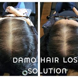 Damo Hair Loss Solution